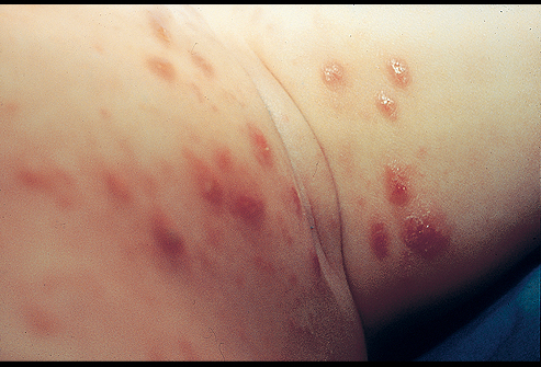 CDC - Scabies