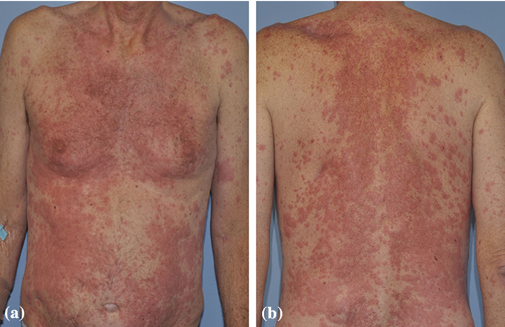 My Voice Side effects of chemotherapy and immunotherapy for head and