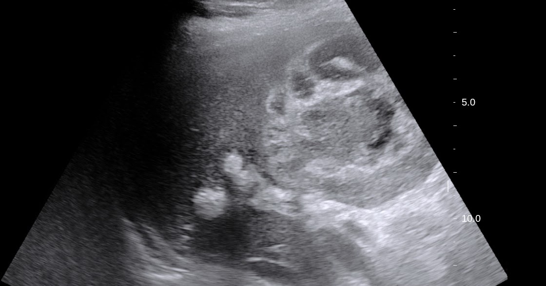 VIETNAMESE MEDIC ULTRASOUND CASE 498 GALLBLADDER ABSCESS, Dr PHAN