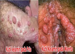 Beli Obat Kutil Kelamin di Apotik Semarang