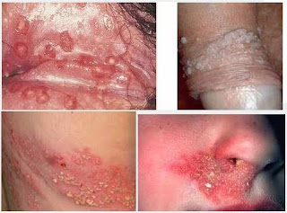 Berapa Harga Obat Herpes Gangjie Ghosiah Di Bantaeng