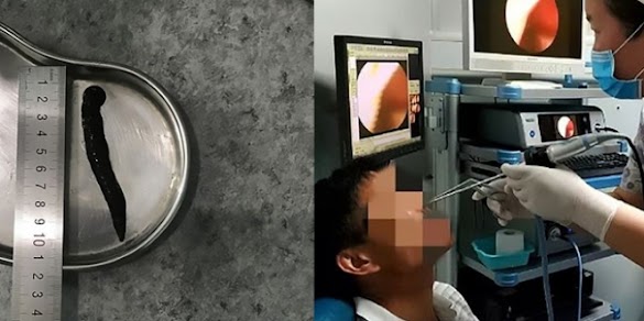 Hidung Berdarah 10 Hari, Ketika Diperiksa Ternyata Isinya... Hidung Berdarah 10 Hari, Ketika Diperiksa Ternyata Isinya...