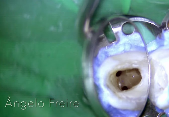 ENDODONTIA: Tratamento de canal reconstrução de furca dente 36