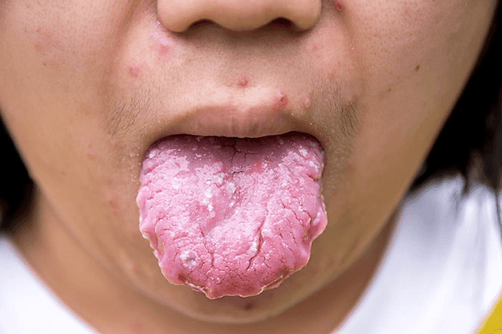 infection non vaginal yeast Infection non vaginal yeast