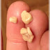 Permanent Cure For Tonsil Stones-Proven