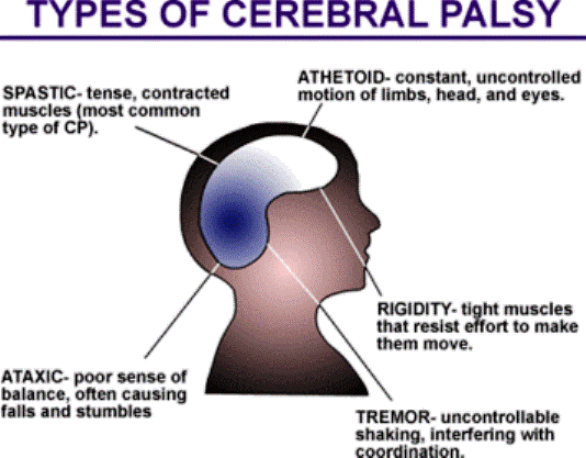 Types Of Cerebral Palsy