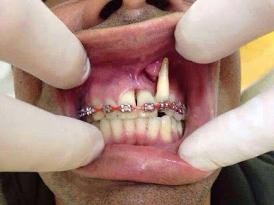 Pemasangan Behel Gigi yang salah