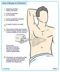 How to Heal Armpit Rash: 10 Steps (with Pictures) - wikiHow