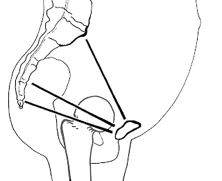 The lines represent (from the top) the pelvic inlet, the midpelvis, and the outlet diameters.