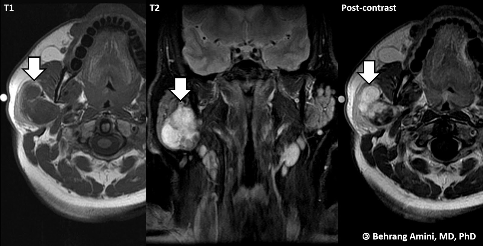 pleomorphic adenoma radiology