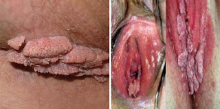 Foto Penyebab Tumbuh Kutil Kelamin Di Vulva