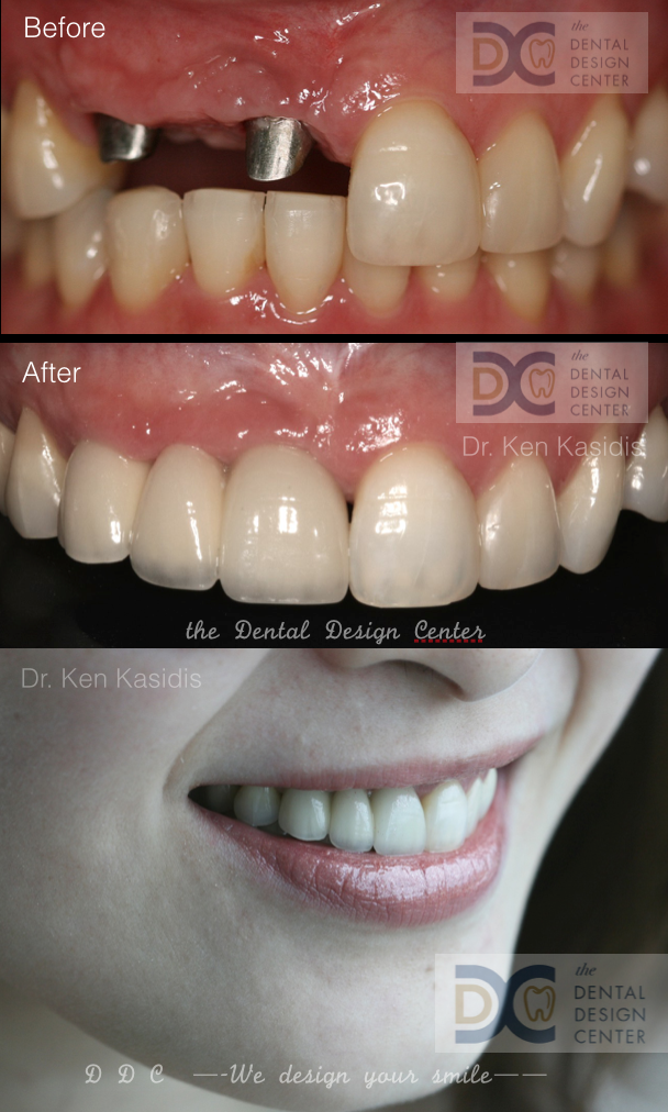Anterior dental implants Dental Design Center Dental Clinic Pattaya