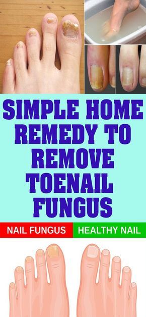 SIMPLE HOME REMEDY TO REMOVE TOENAIL FUNGUS - DIY CRAFT PLUS