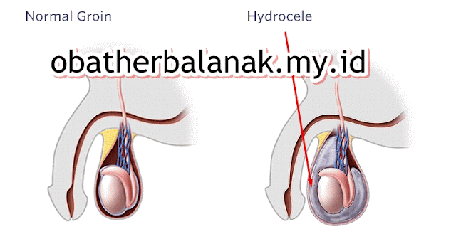 Obat Hidrokel Paling Dipercaya Para Ahli
