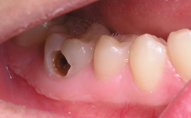 Điều trị sâu răng