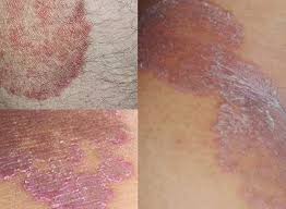 cara mengobati eksim kering dengan cepat pake obat 100 Herbal