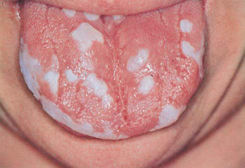 White Oral Lesion 37