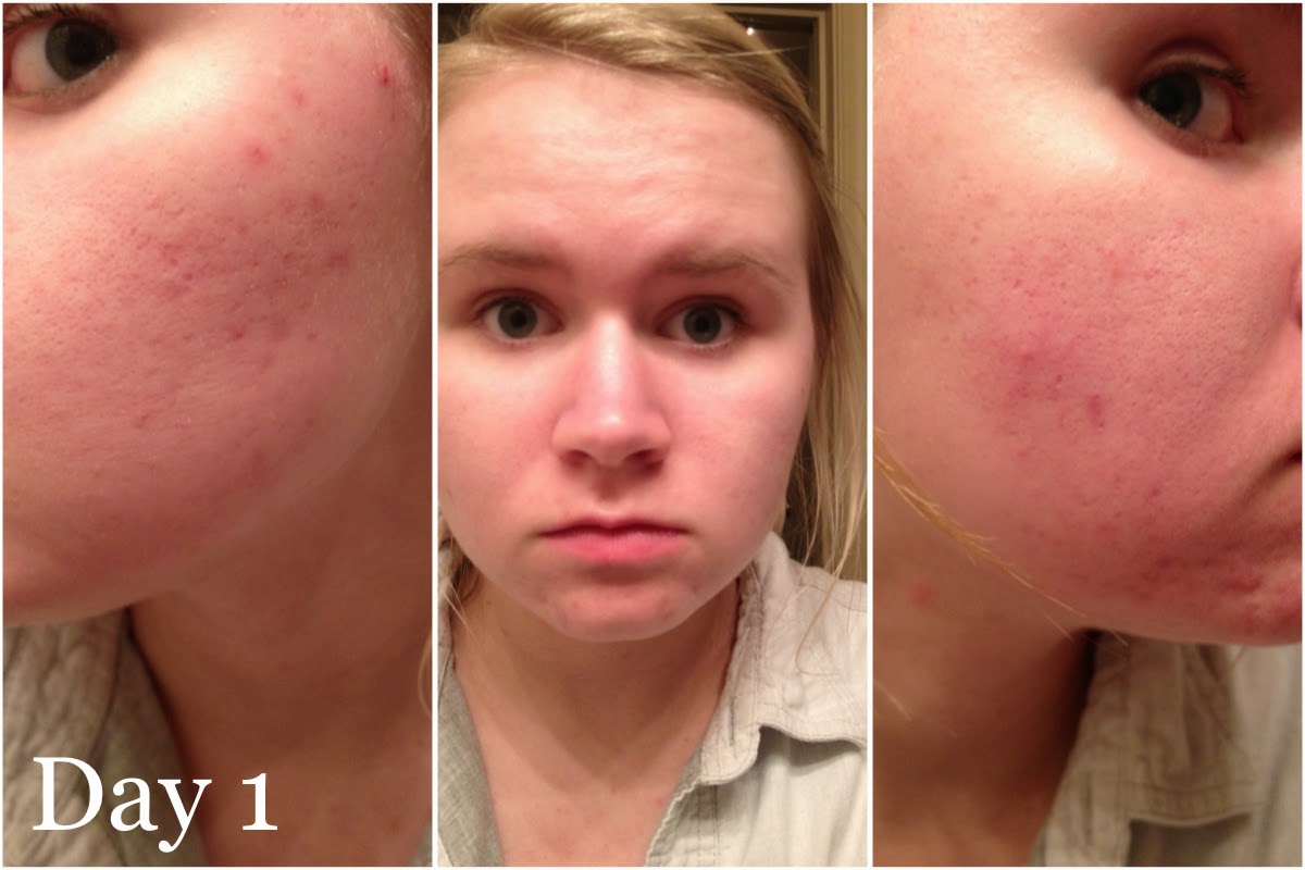 Cheap Accutane For Sale Online