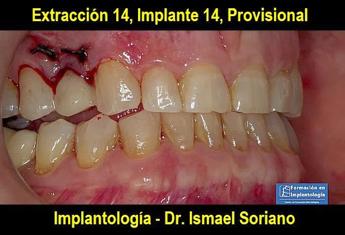 IMPLANTOLOGÍA: Extracción 14, Implante 14, Provisional - Dr. Ismael Soriano