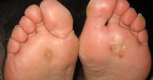 Plantar Warts - Removal, Treatment, Pictures, Causes, Remedies