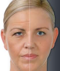 nowyouknow: Botox might make you look younger - and feel more sad. The
