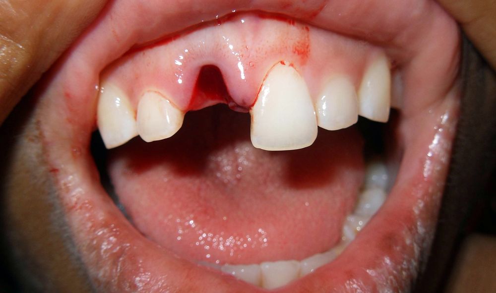 Avulsão Dentária