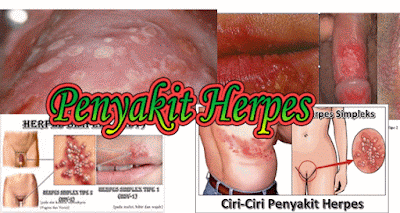 gambar penyakit herpes luka lecet dikelamin