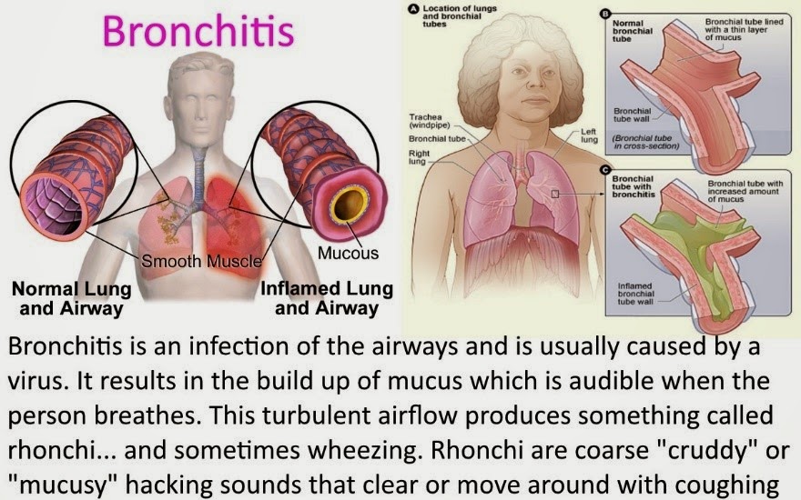 Mommy s Diary Of Life APA ITU PNEUMONIA BRONKITIS KEPADA KANAK KANAK 