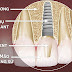Những trường hợp tiêu xương hàm quá nhiều thì có nên cắm implant không?