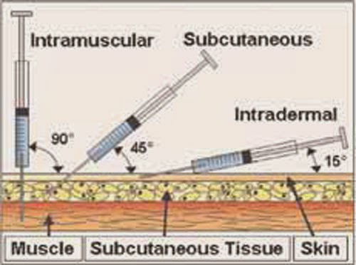 Angle Of Injection Nursing angle-of-injection-nursing