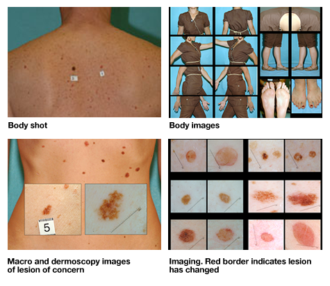 Sun Damaged Skin Pictures: Sunburn, Melanoma, Carcinoma ...