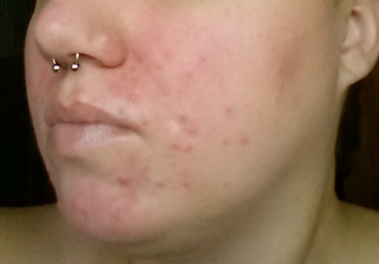 demodex brevis rash
