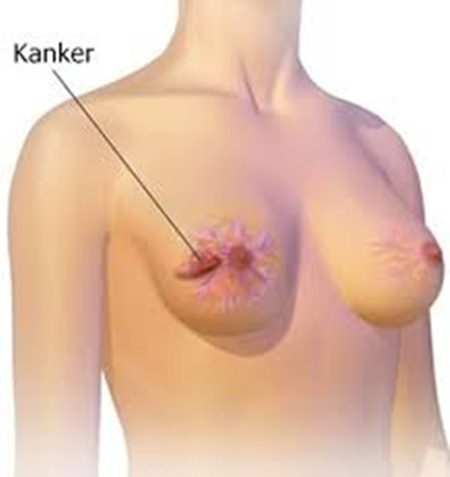 Kanker payudara genetik, jenis obat kemoterapi kanker payudara, kanker payudara usu, kanker payudara makalah, cara membuat obat kanker payudara dengan daun sirsak, kanker payudara epidemiologi, daun obat kanker payudara, obat kanker payudara femara, kanker payudara menurut who tahun 2012, kenali gejala awal kanker payudara, kanker payudara filetype pdf