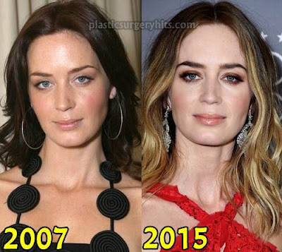 Emily Blunt Plastic Surgery Before And After Nose Job And Breast