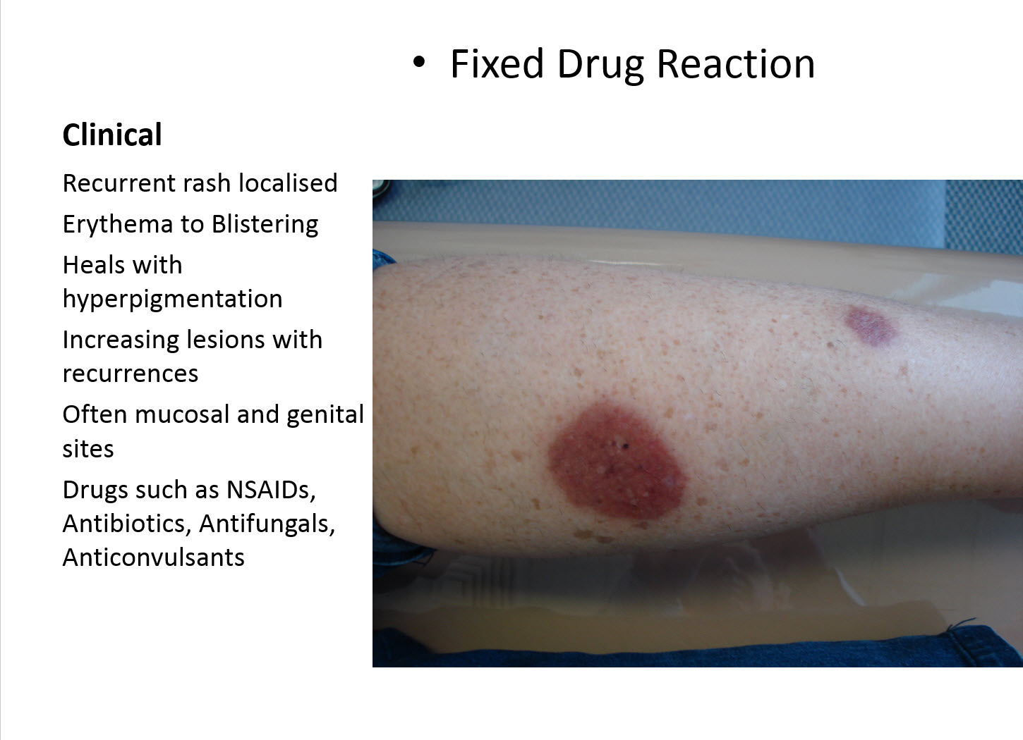 Dermatopathology Made Simple Inflammatory Interface Vacuolar