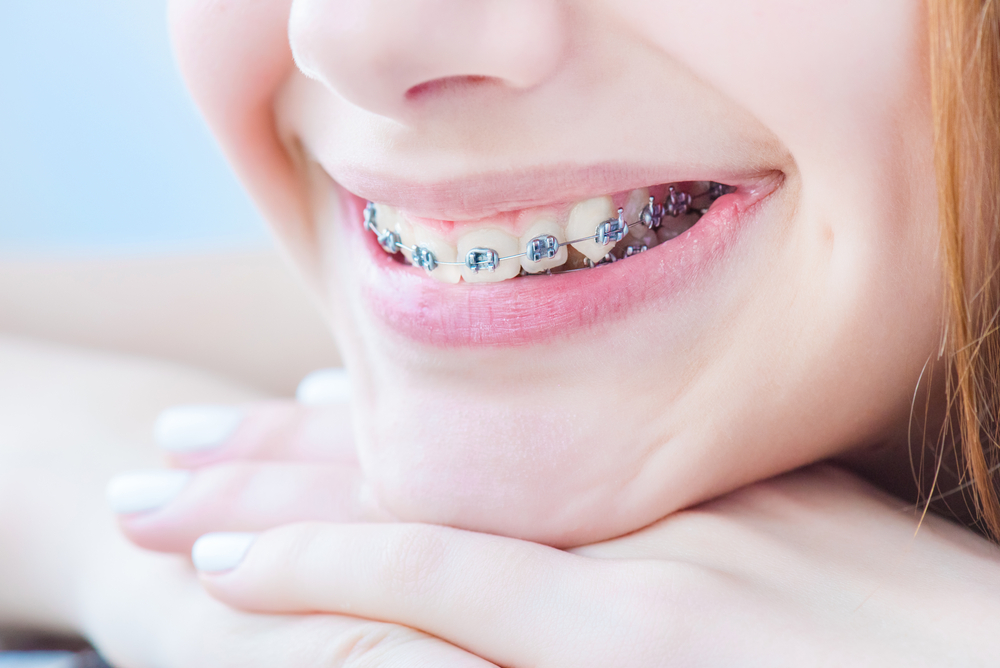 Dental Braces Types Advantages And Disadvantages