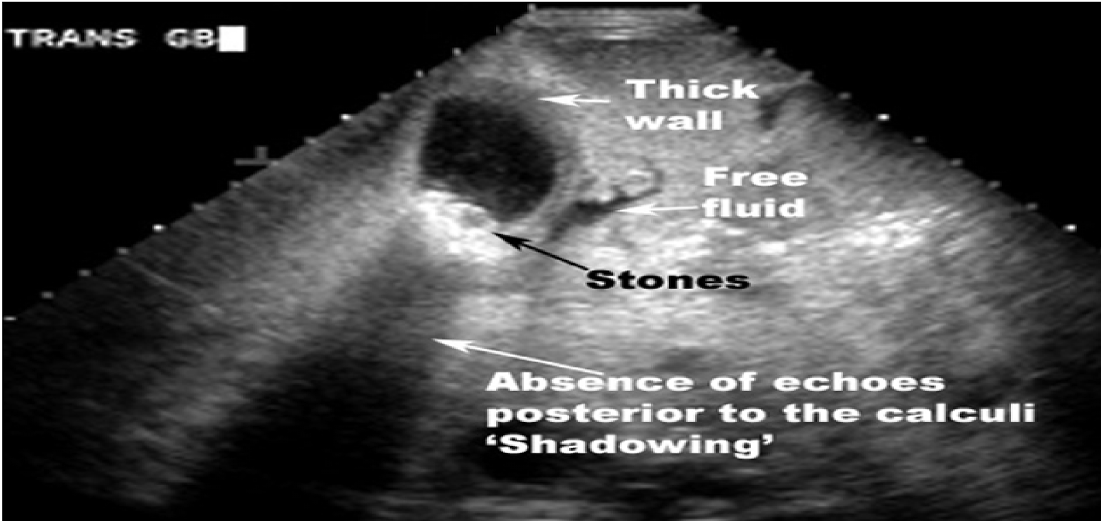 Acute Cholecystitis Natural Treatment Acute Cholecystitis Natural Treatment