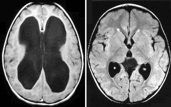 Hidrosefalus dan otak normal