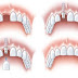 Trồng răng implant bao lâu hết sưng ?