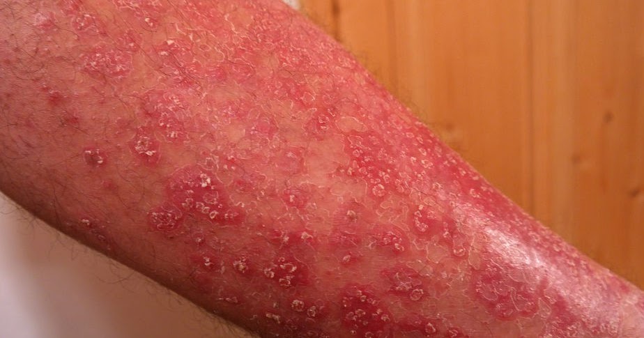 Psoriasis knees 