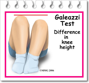 ORTHOPEADIC GROUP 4 : ♥ Fiza Nadia Anis Saniah Rija ♥: CONGENITAL HIP ...