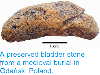 http://sciencythoughts.blogspot.co.uk/2014/10/a-preserved-bladder-stone-from-medieval.html