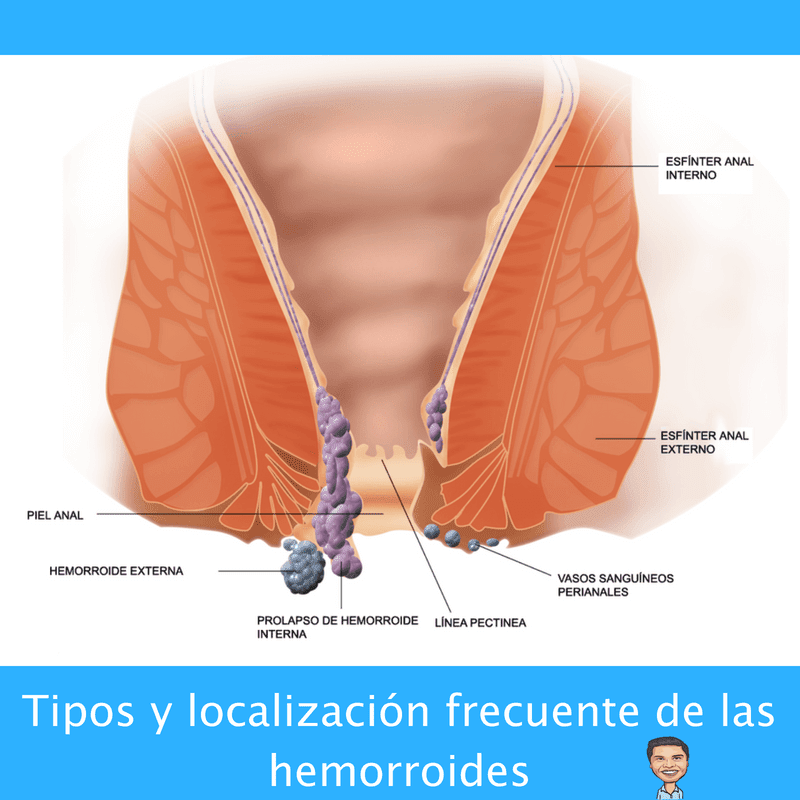 erección de hemorroides erección de hemorroides