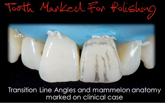 COMPOSITE RESTORATION: Creating natural enamel surfaces with composite resin - Clinical Case
