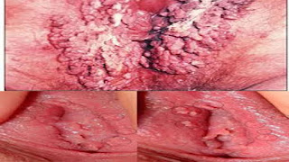 Obat Alami Daging Kutil Kelamin Pada Vagina Paling Cepat Sembuh Obat Alami Daging Kutil Kelamin Pada Vagina Paling Cepat Sembuh