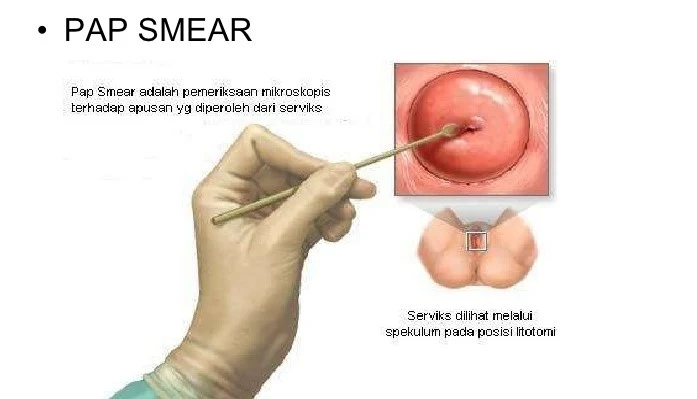 Pap Smear Test