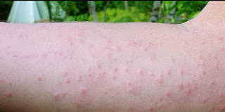 Itchy rashes caused by exposure to brown tail moth brown tail moth rash pictures