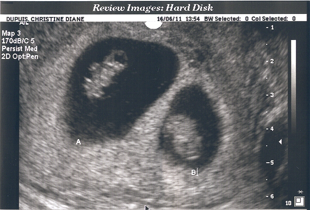 My Journey Through Infertility 9 Weeks 1 Day my-journey-through-infertility-9-weeks-1-day