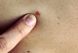 Skin Cancer Picture