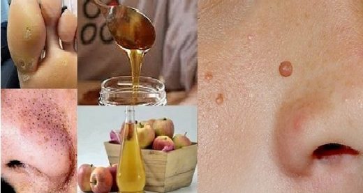 How To Reduce Moles, Warts, Tangles And Brown Spots!